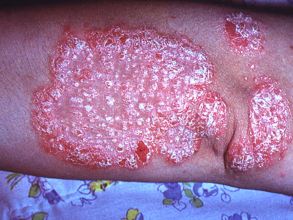 psoriasis