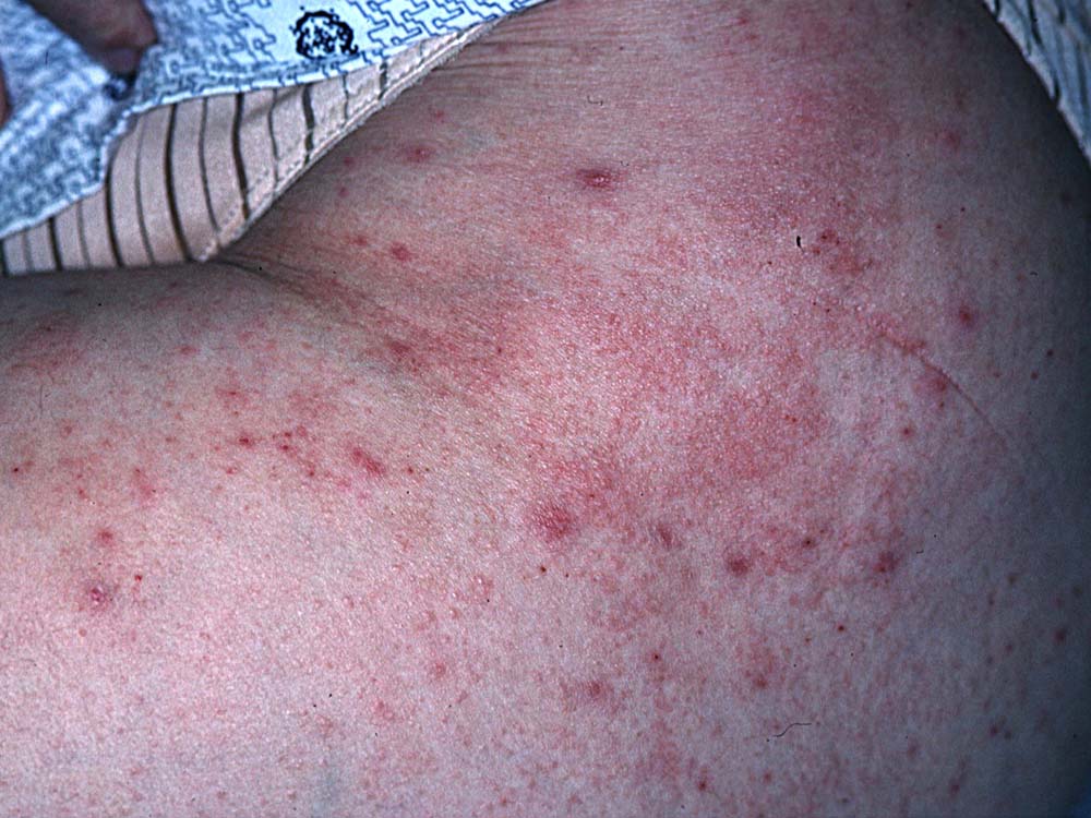 Pp Rash pruritic urticarial papules of pregnancy (PUPP)