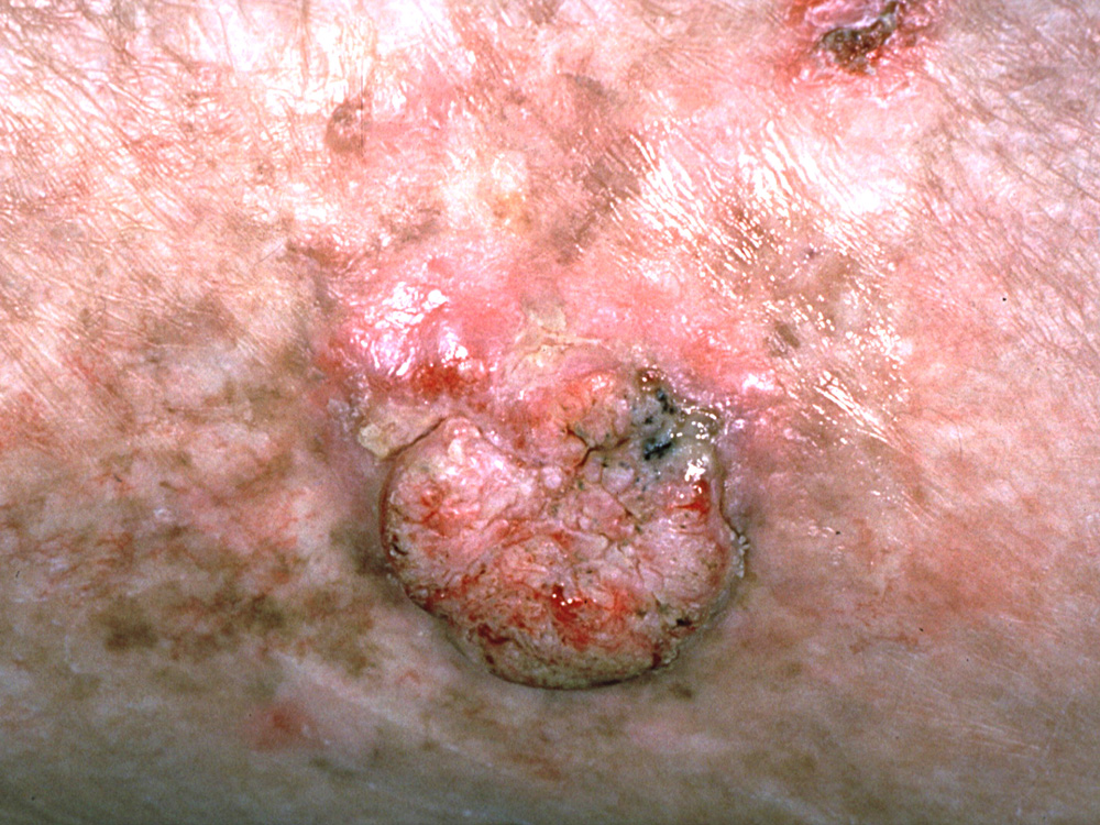 squamous cell carcinoma