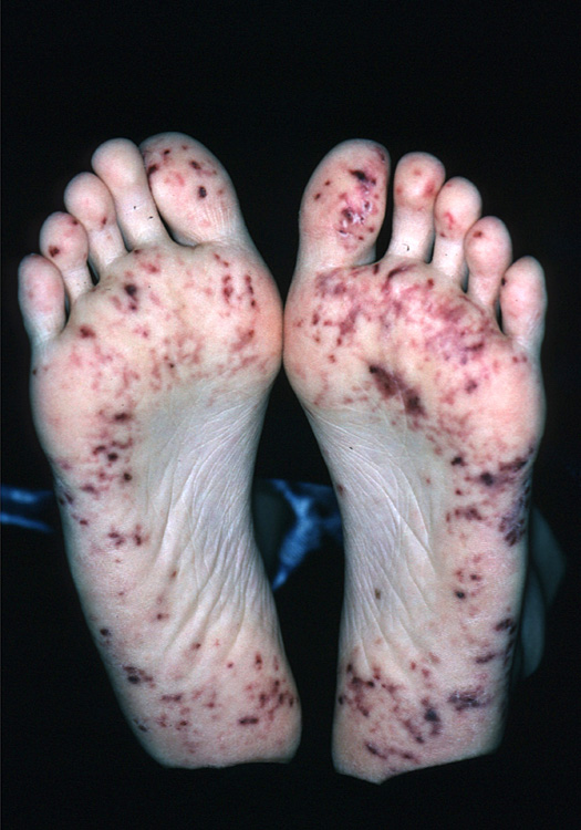 lupus erythematosus, systemic