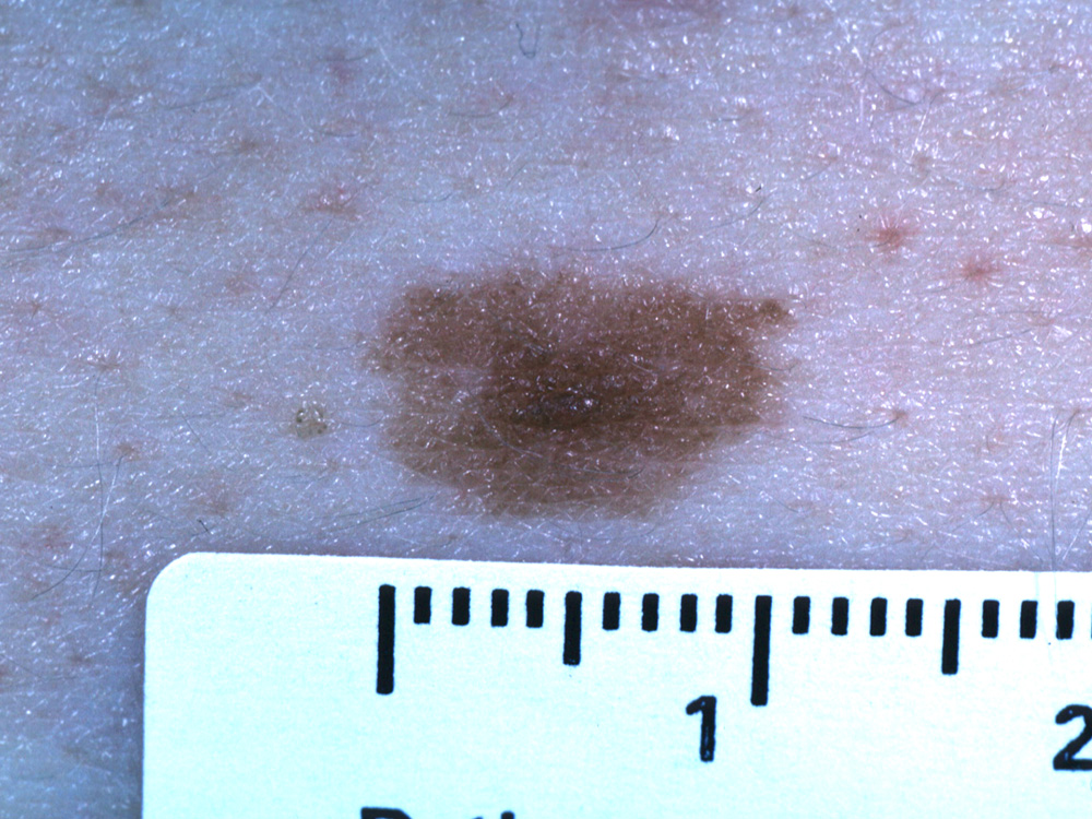 nevus, dysplastic
