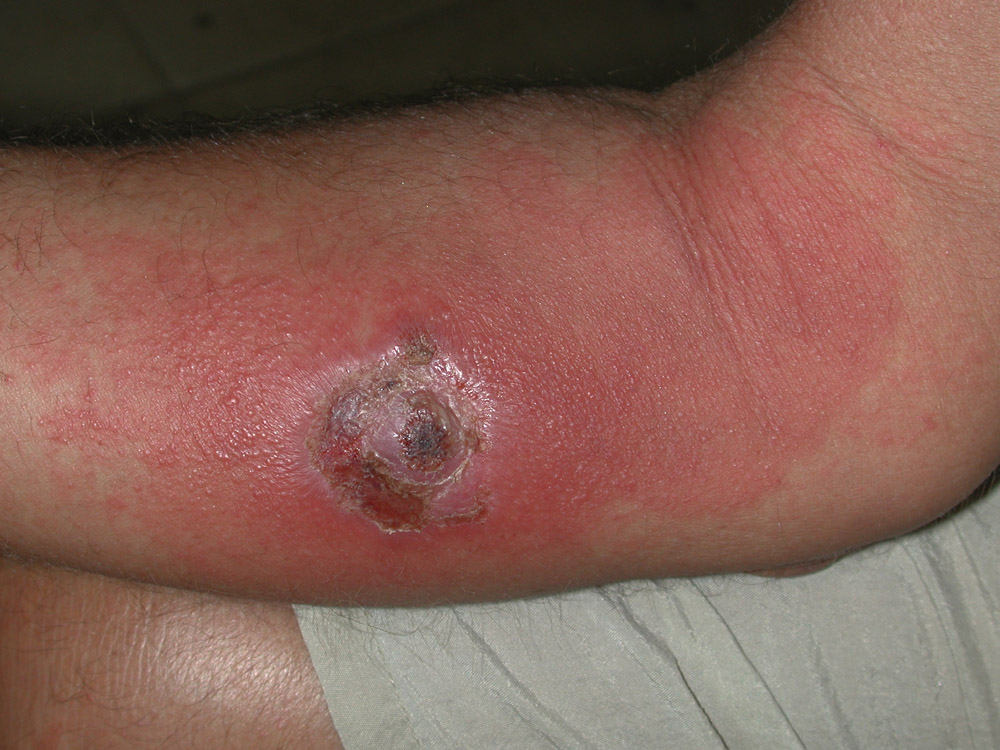 leishmaniasis