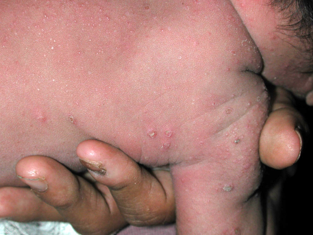 scabies