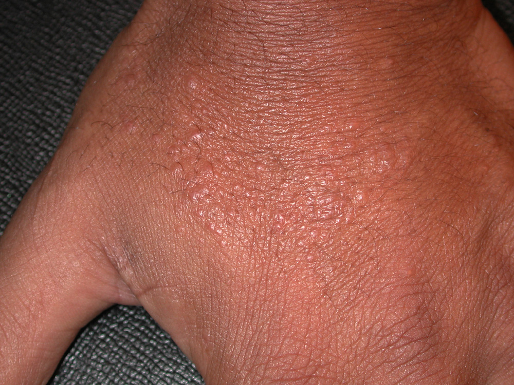 contact dermatitis, irritant