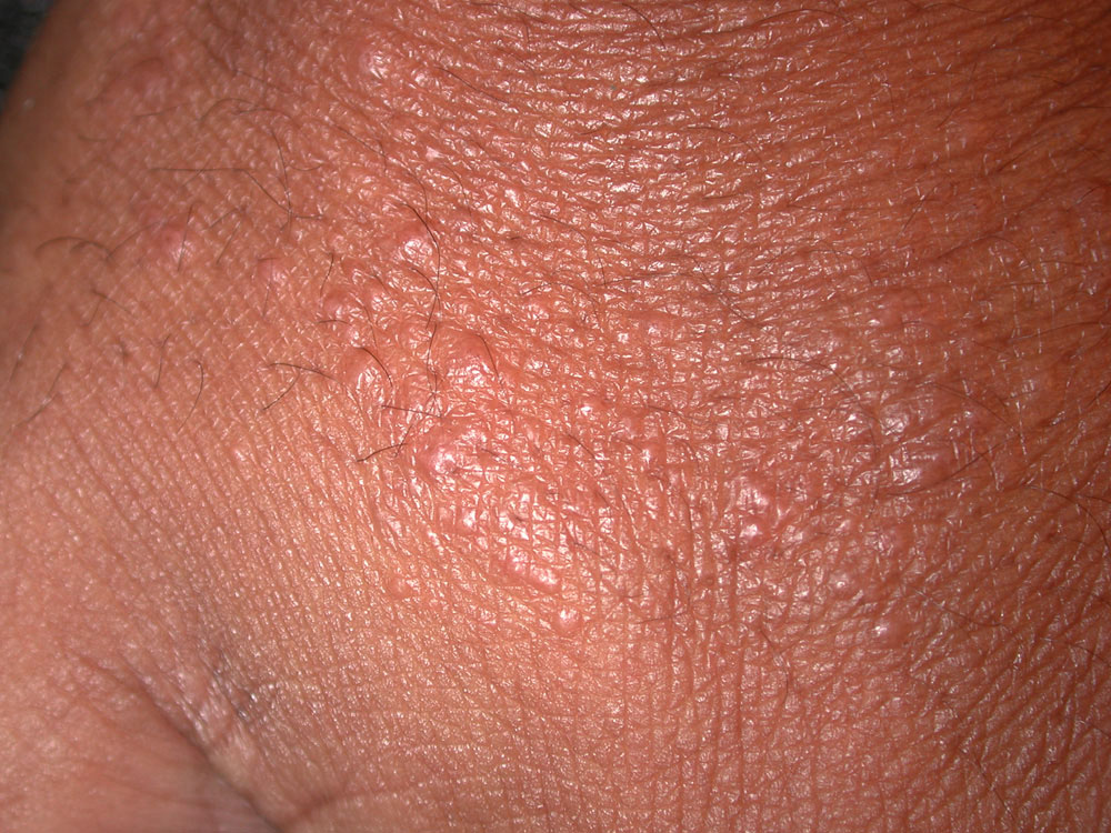 contact dermatitis, irritant