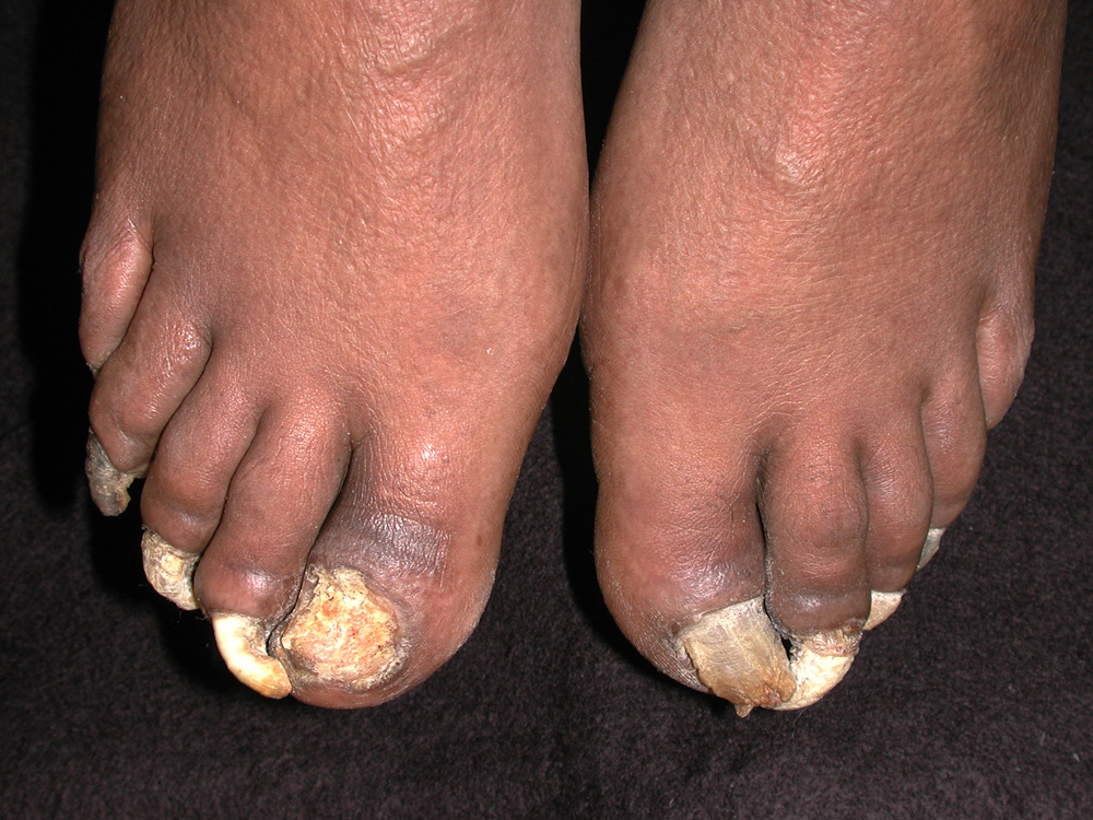 onychomycosis