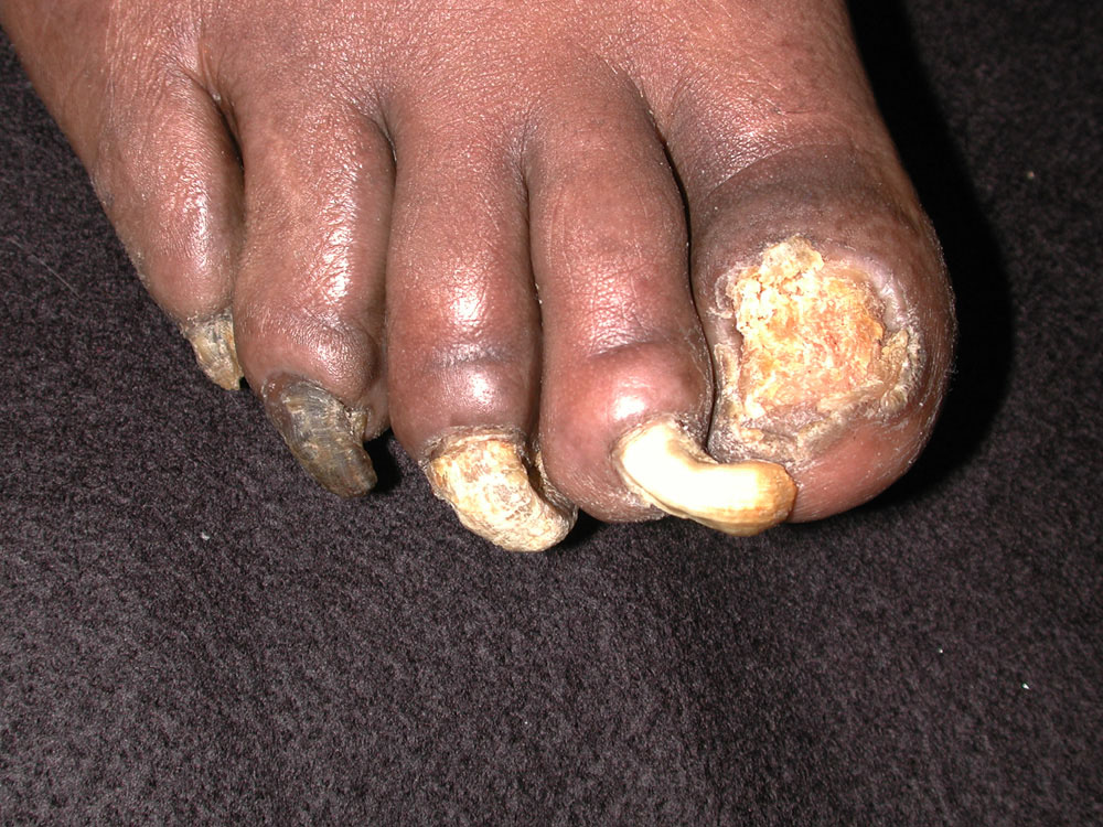 onychomycosis