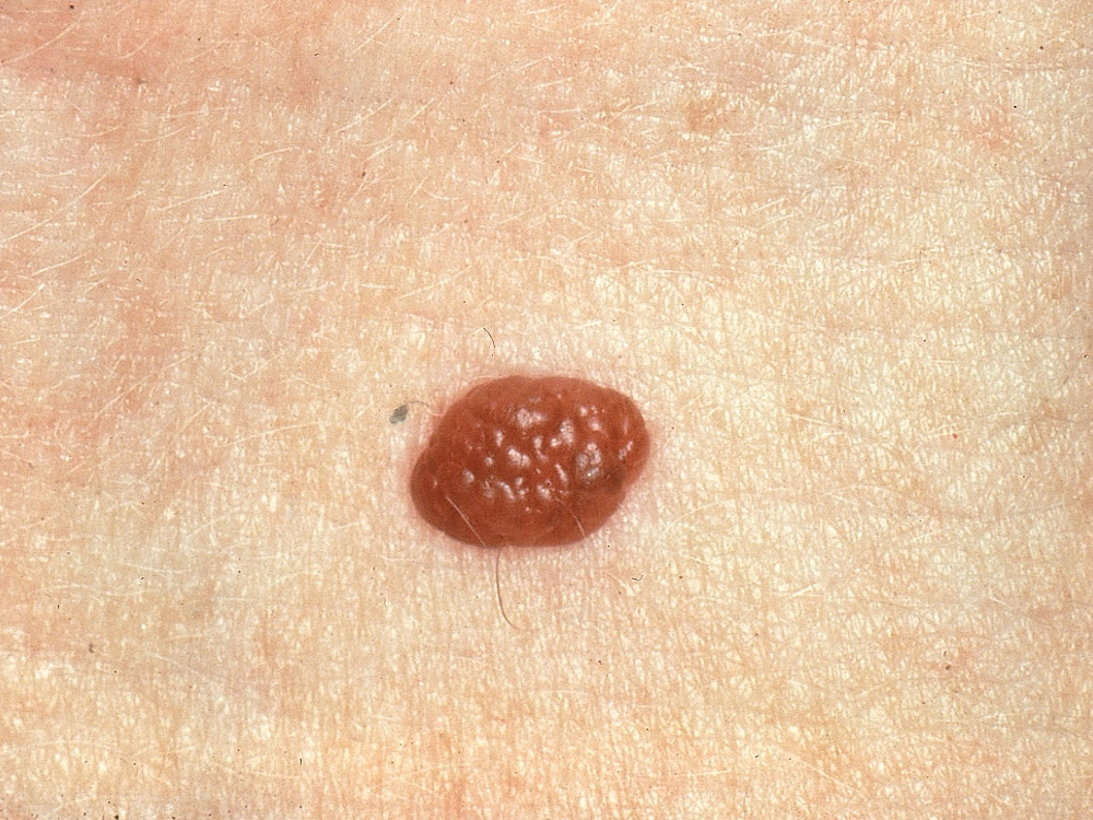 nevus, dermal
