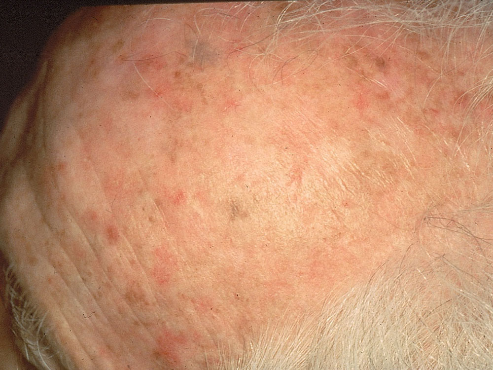 actinic keratosis