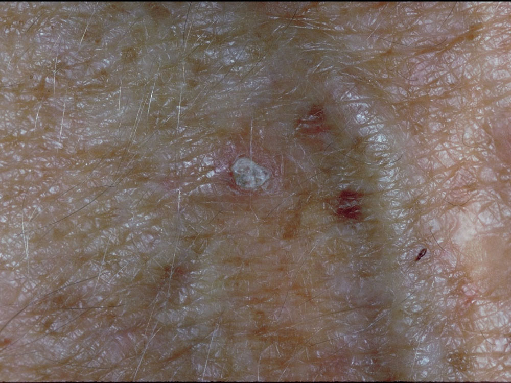 actinic keratosis