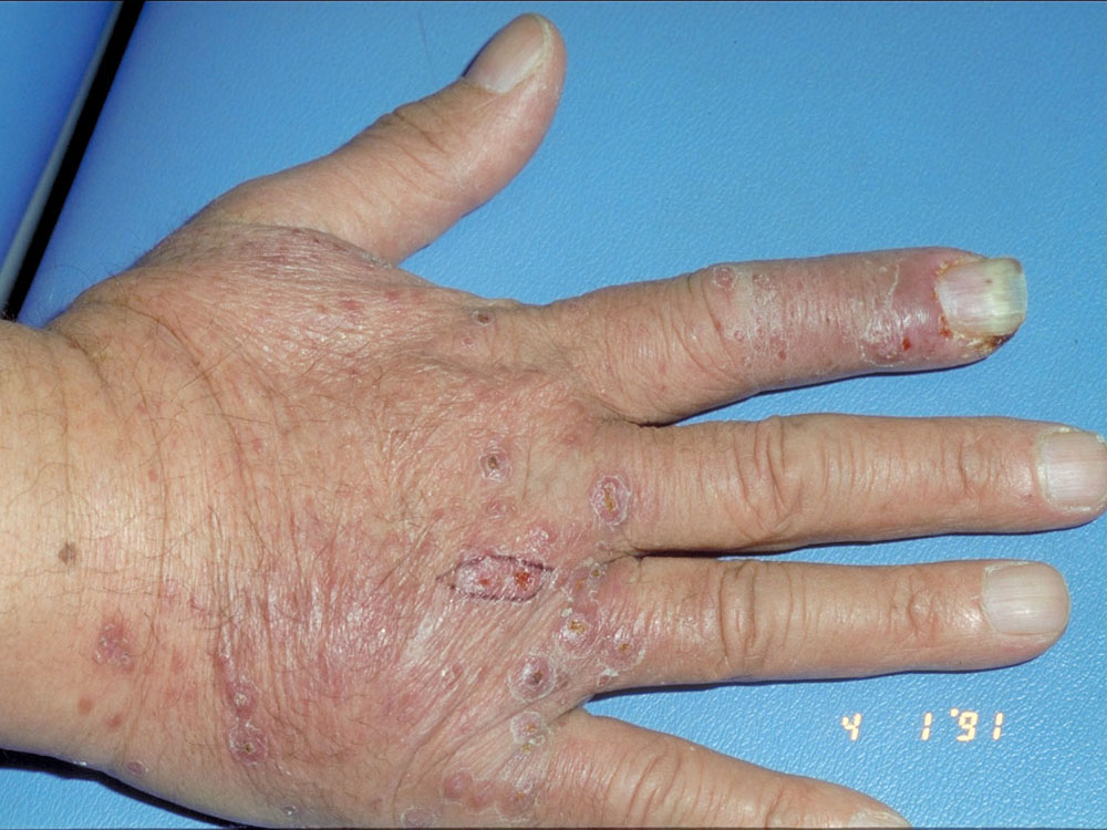 atypical mycobacterium infection