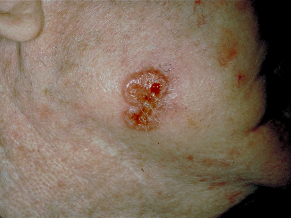 basal cell carcinoma, nodular
