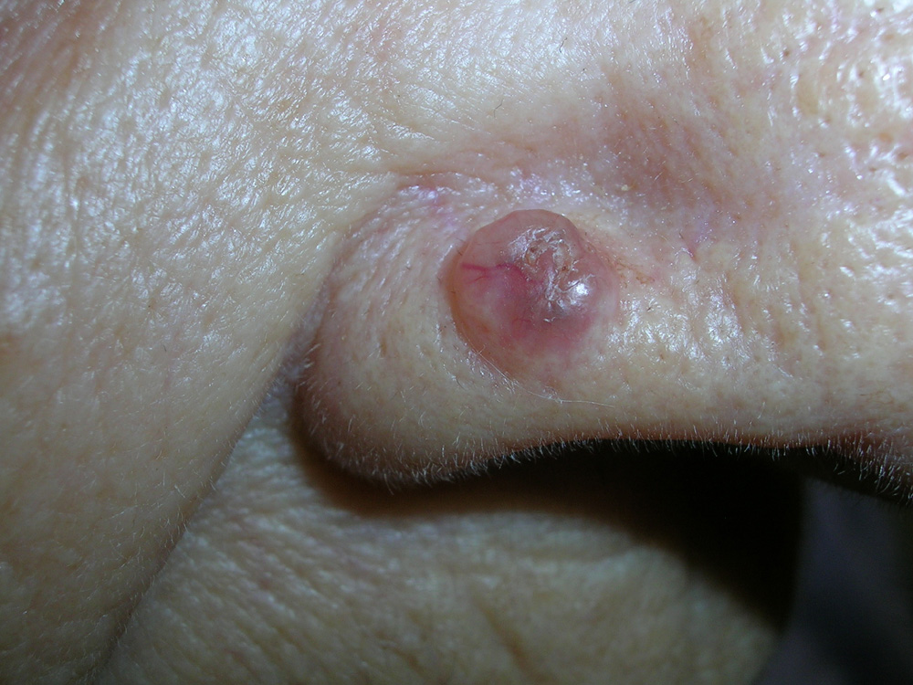 basal cell carcinoma, nodular