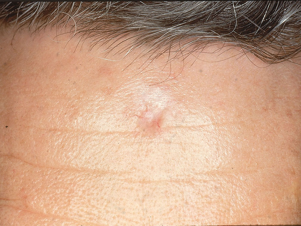 basal cell carcinoma, sclerosing (morpheaform)
