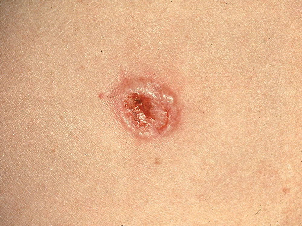 basal cell carcinoma, nodular