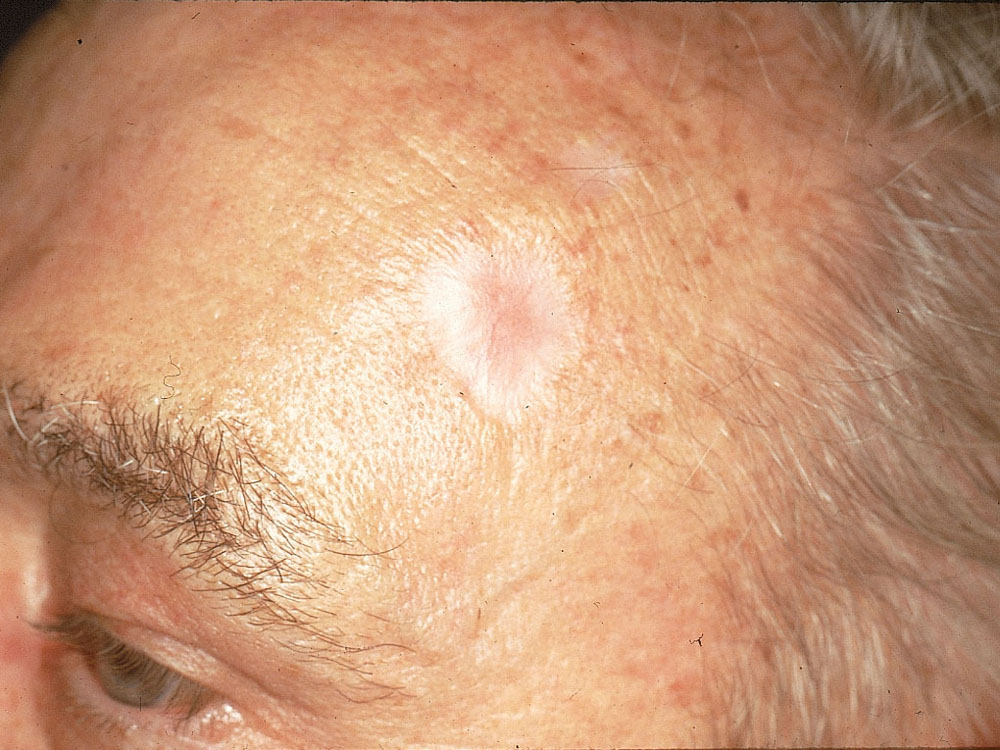 basal cell carcinoma, sclerosing (morpheaform)