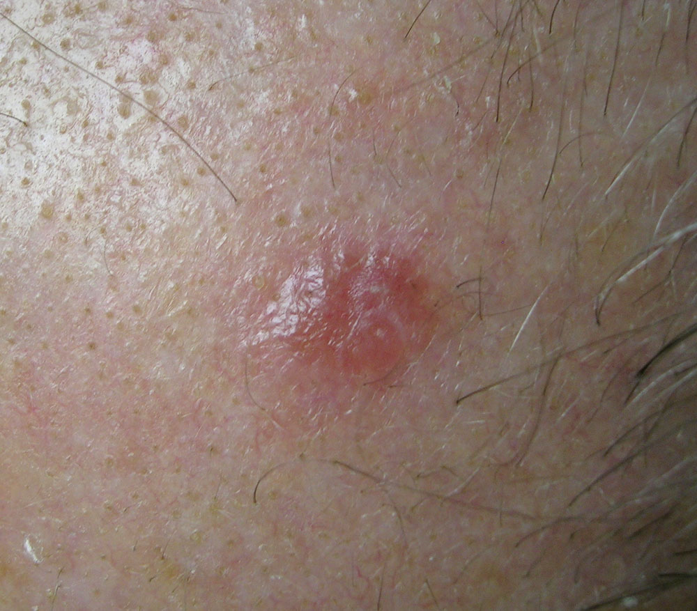 basal cell carcinoma, nodular