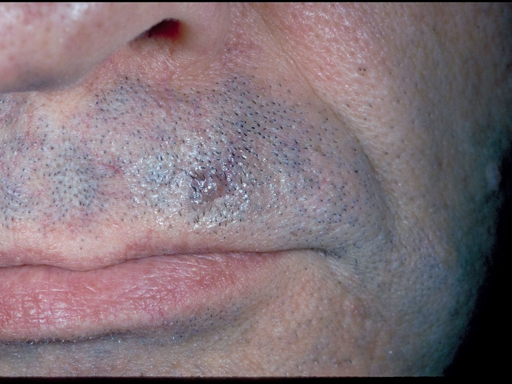 basal cell carcinoma, nodular