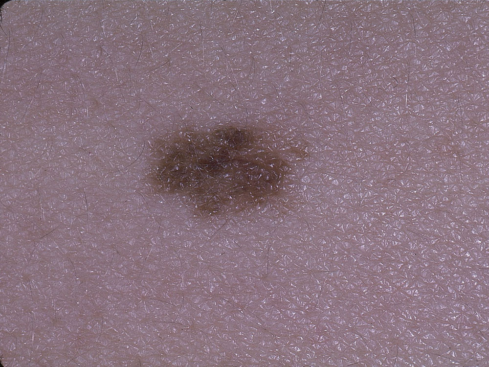 nevus, dysplastic