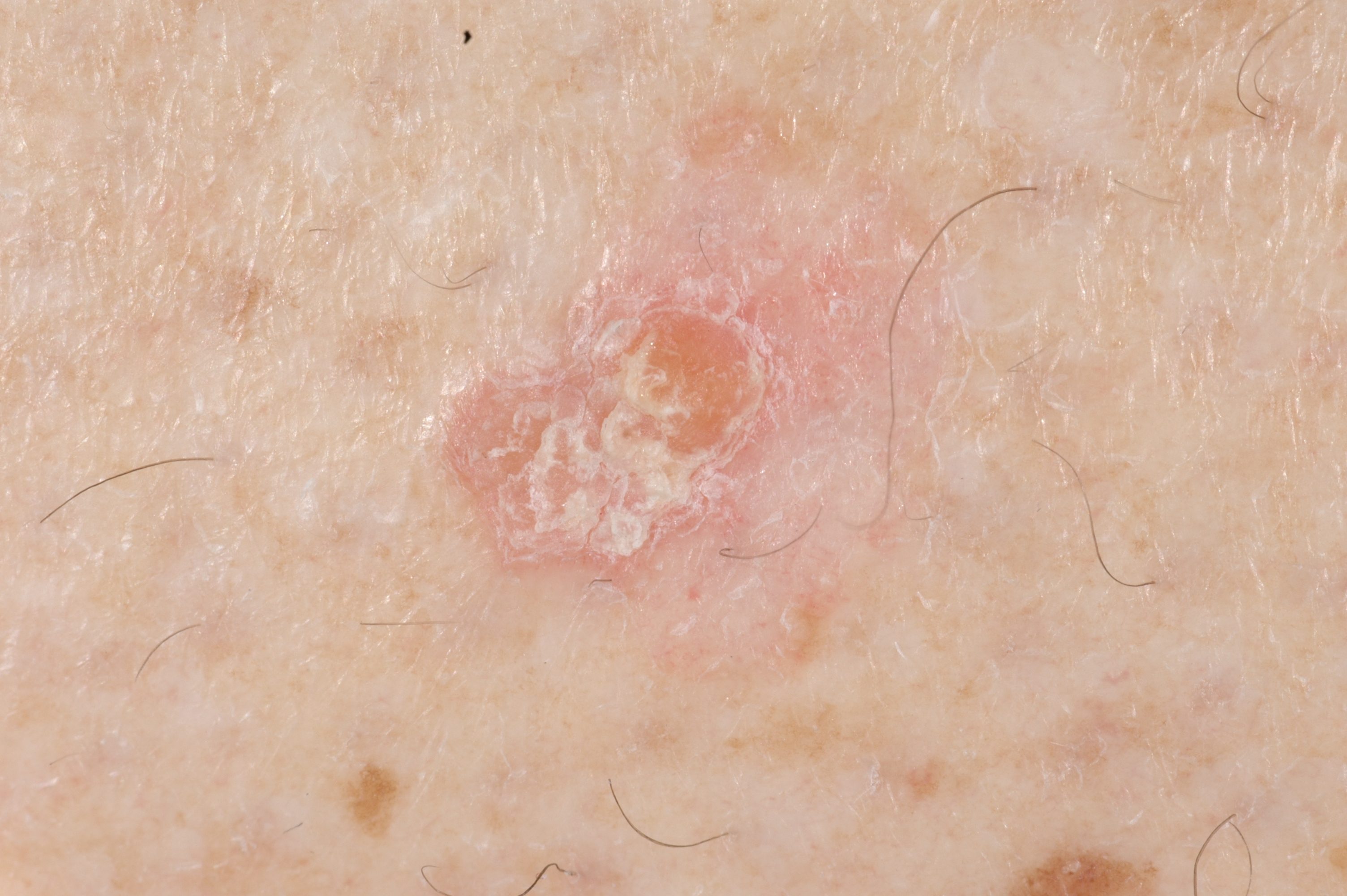 actinic keratosis