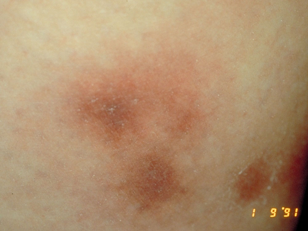 erythema nodosum