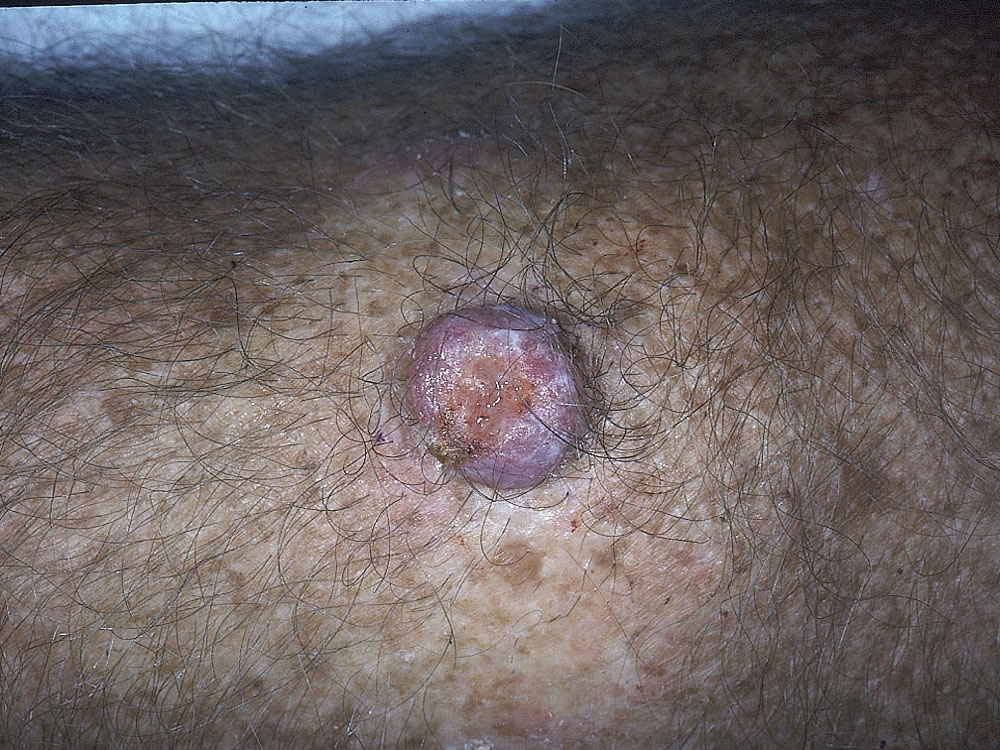keratoacanthoma