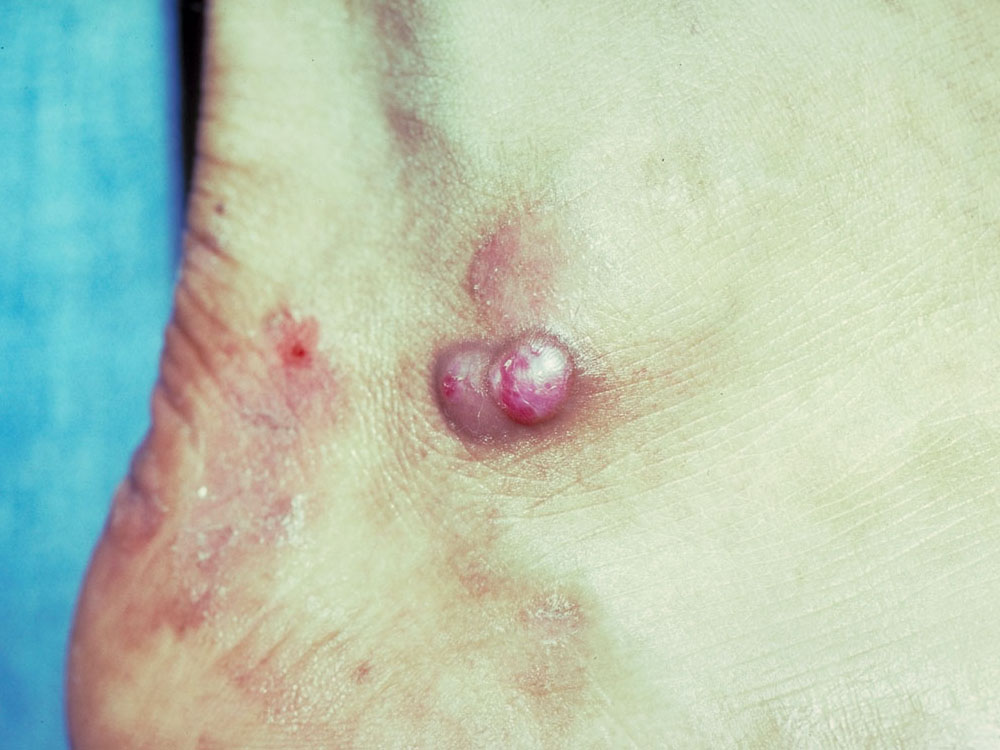 Kaposi's sarcoma