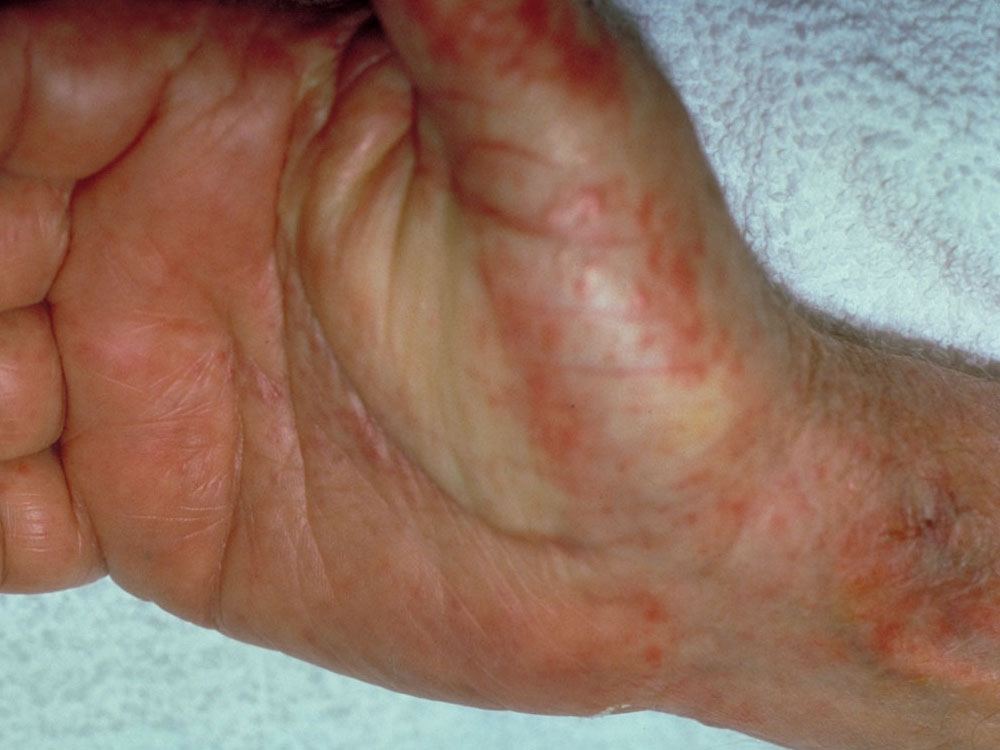 leukocytoclastic vasculitis