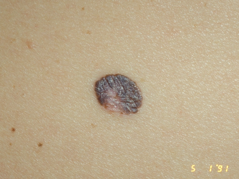 melanoma, superficial spreading