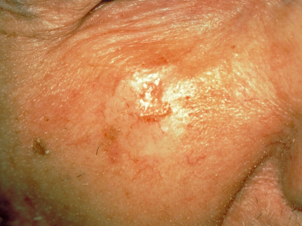 basal cell carcinoma, sclerosing (morpheaform)