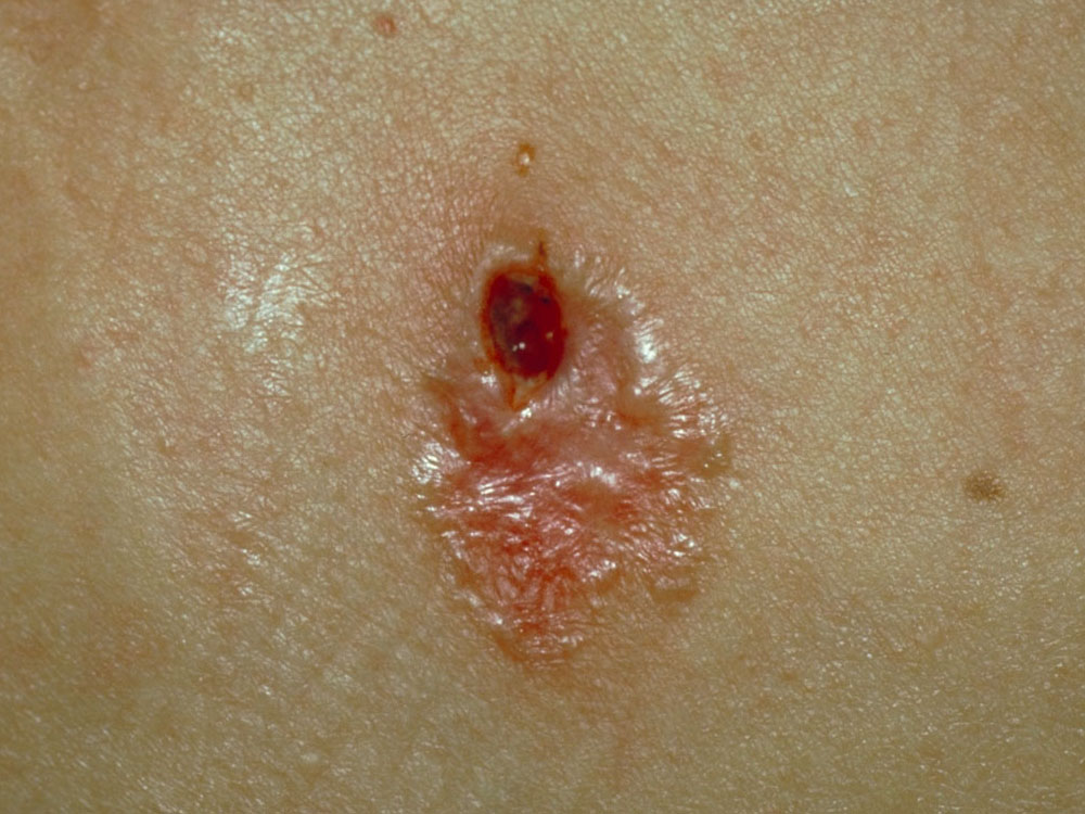 basal cell carcinoma, nodular