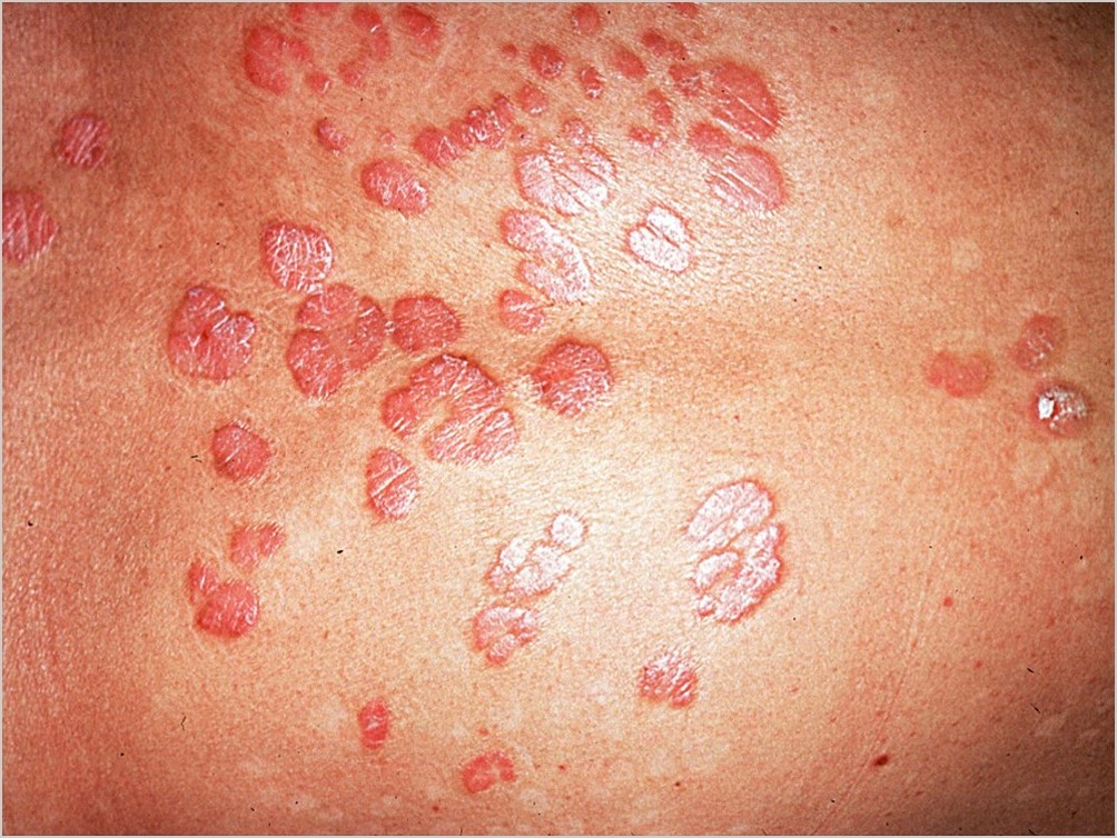 psoriasis