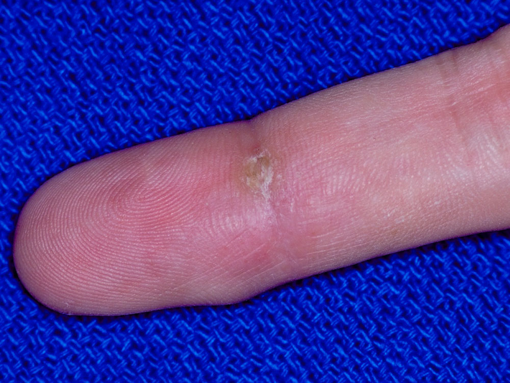 squamous cell carcinoma