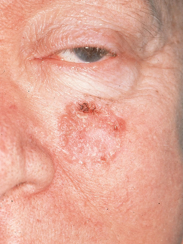 squamous cell carcinoma