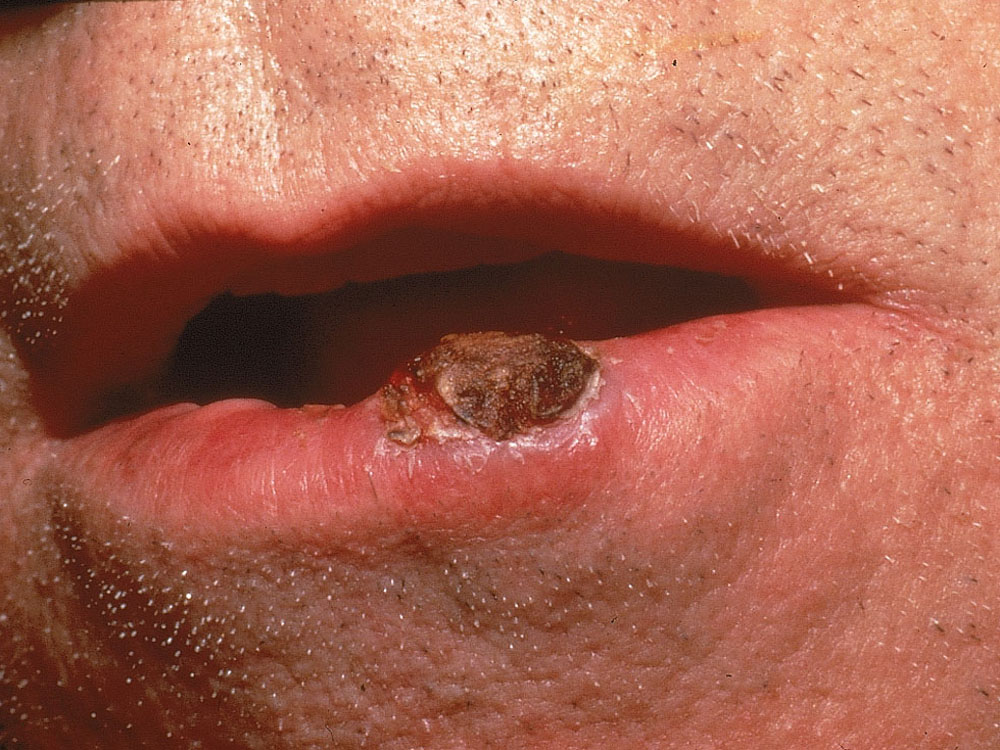 squamous cell carcinoma