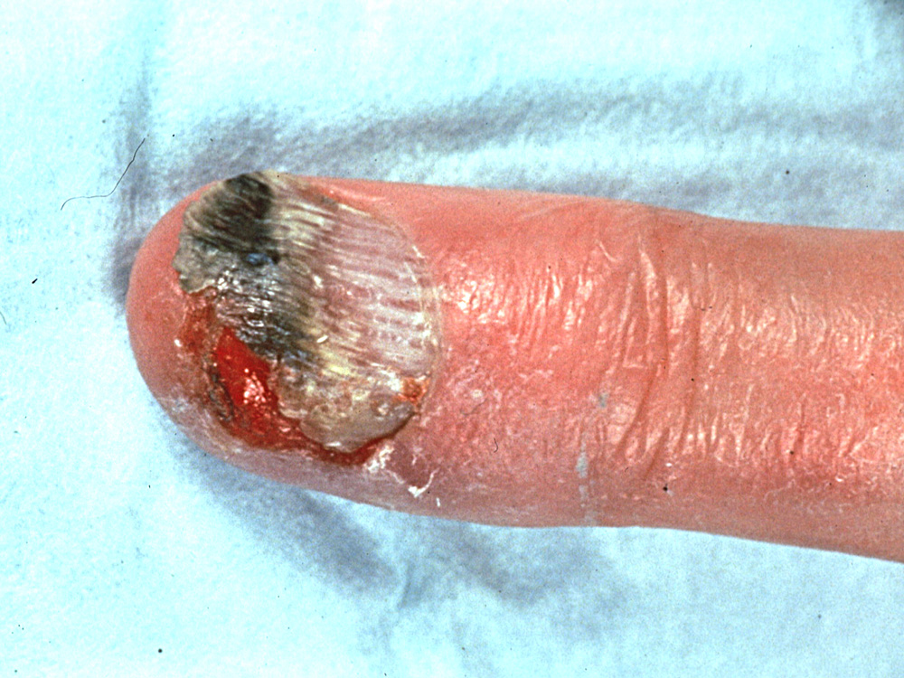 squamous cell carcinoma