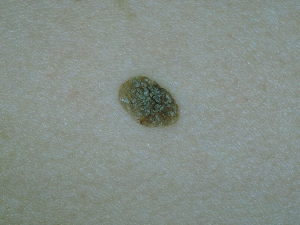 seborrheic keratosis