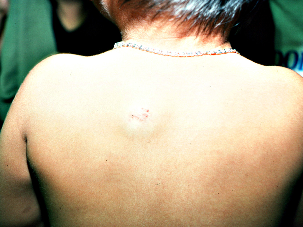 hemangioma, strawberry