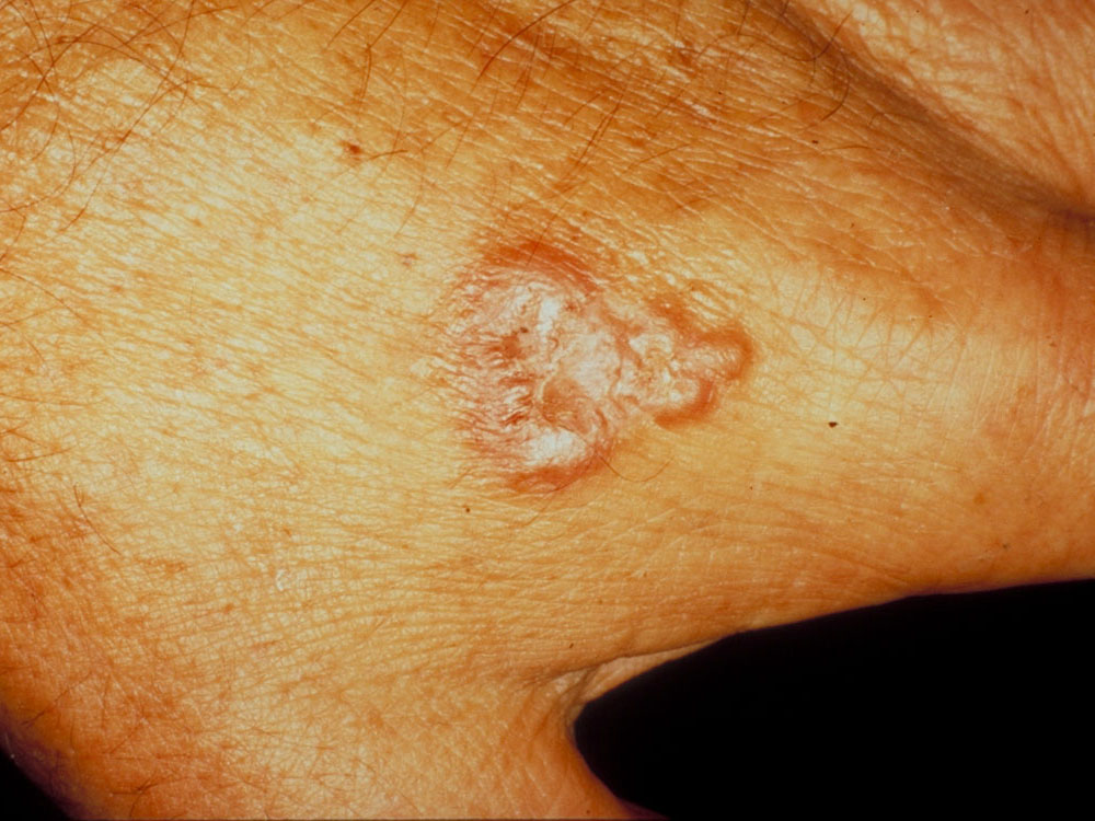 swimming pool granuloma