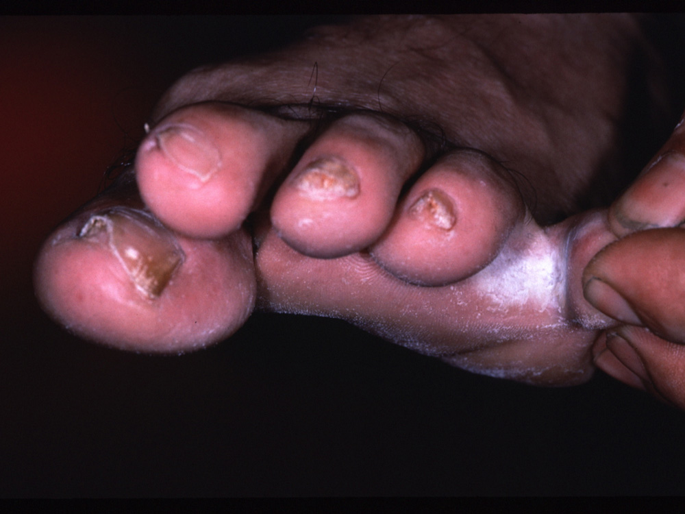 tinea pedis