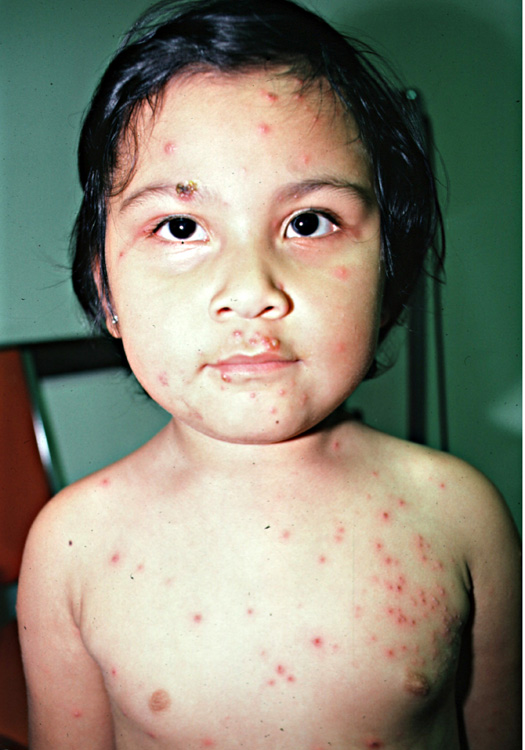 Varisella varicella