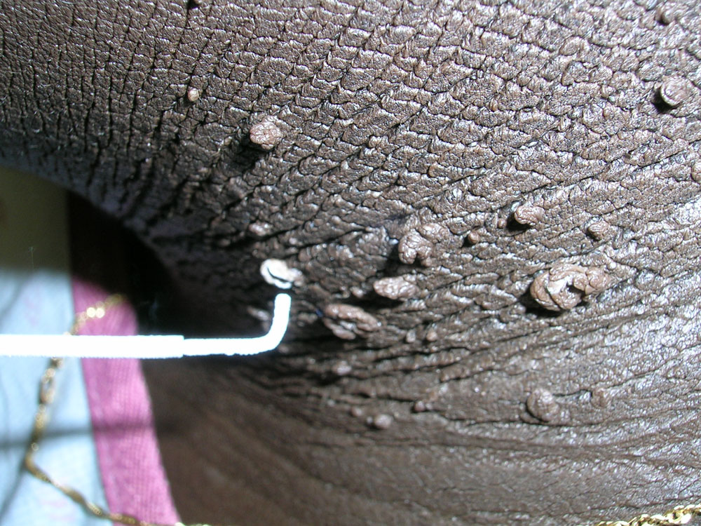 acanthosis nigricans