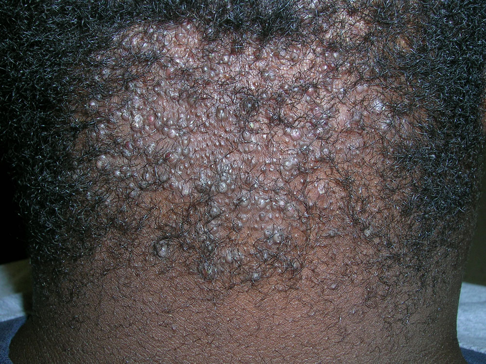 Acne keloidalis