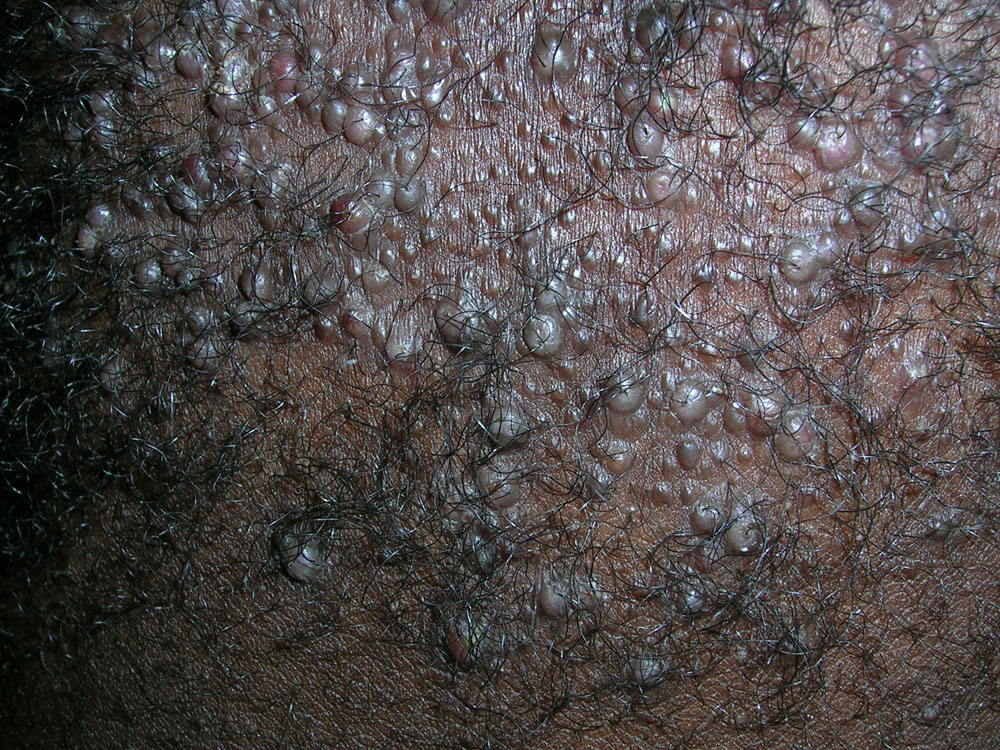 Acne keloidalis