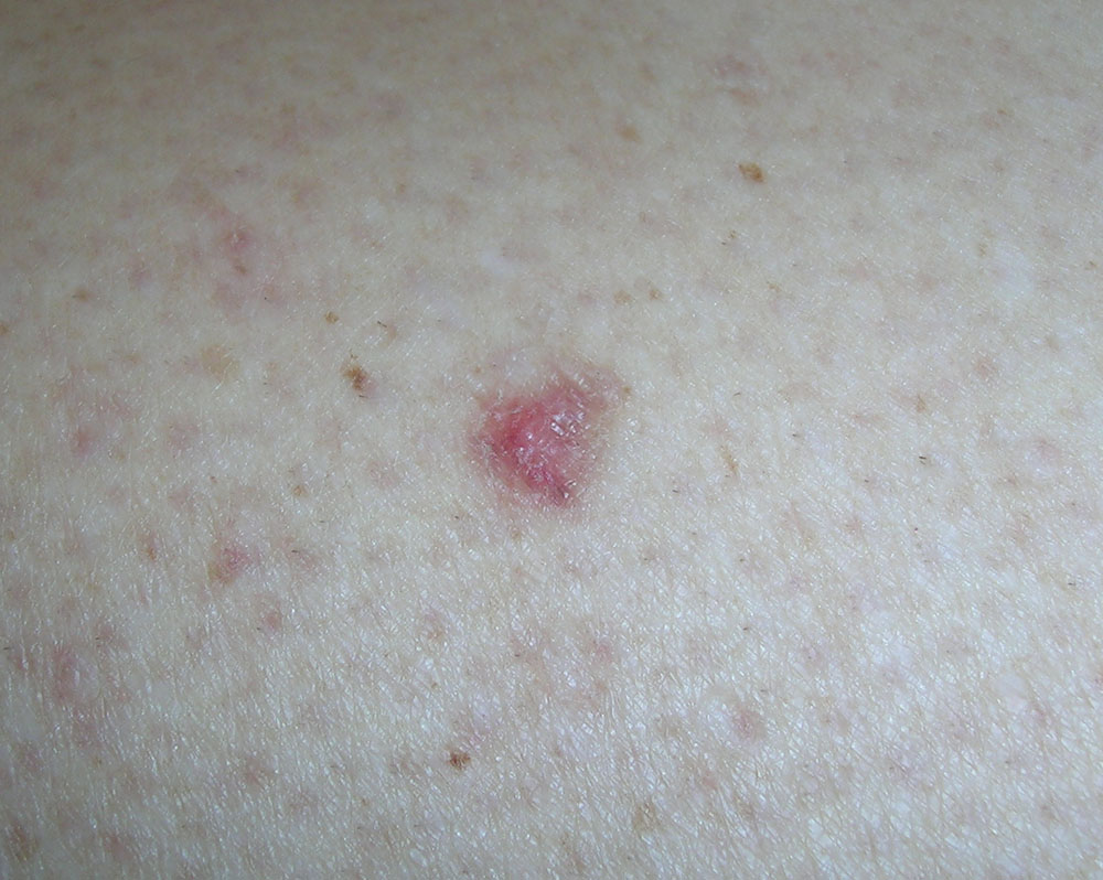 actinic keratosis