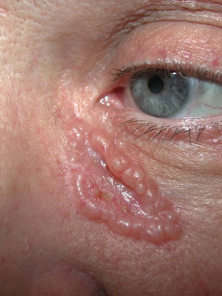 basal cell carcinoma, nodular