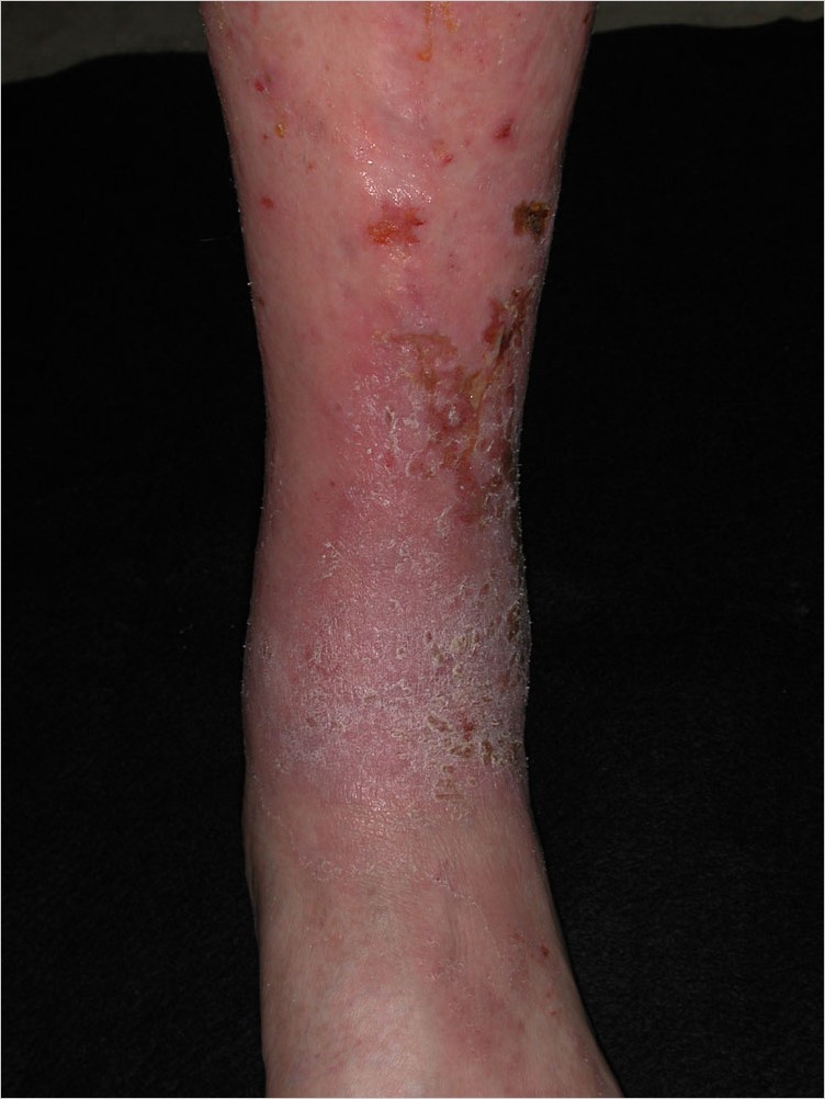 cellulitis