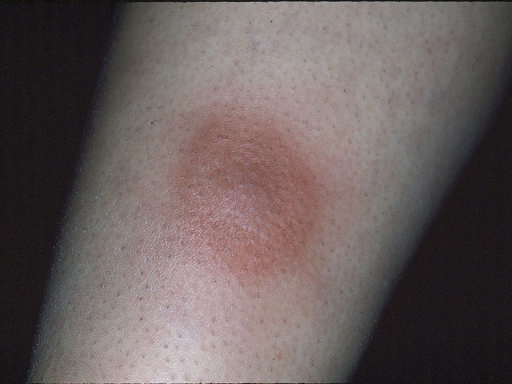 cellulitis