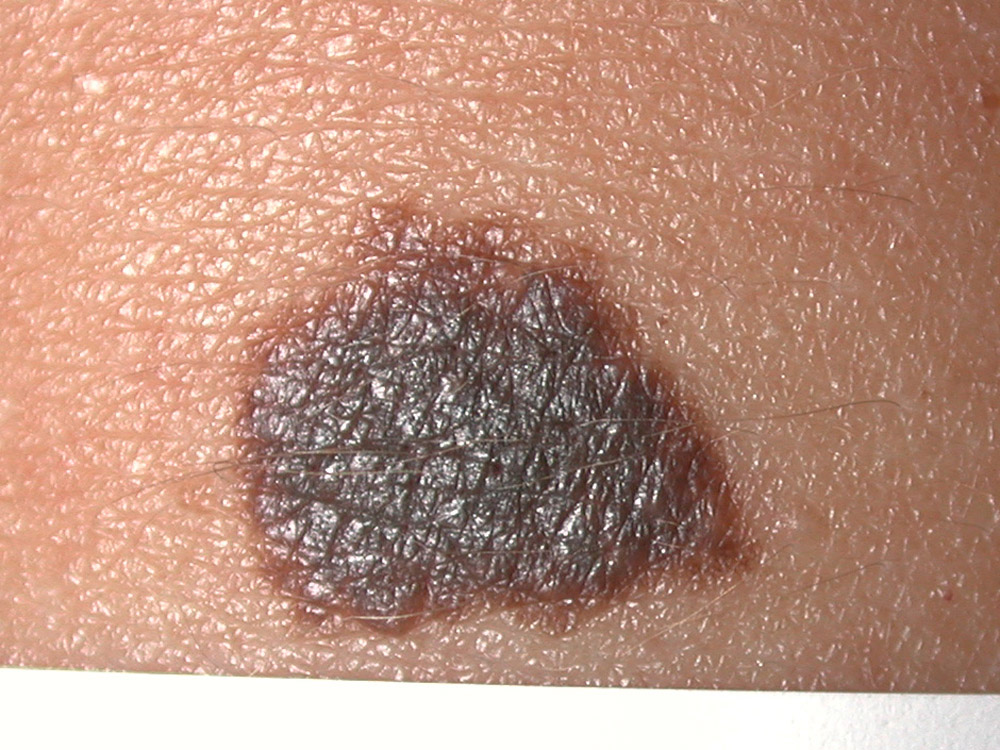 nevus, congenital