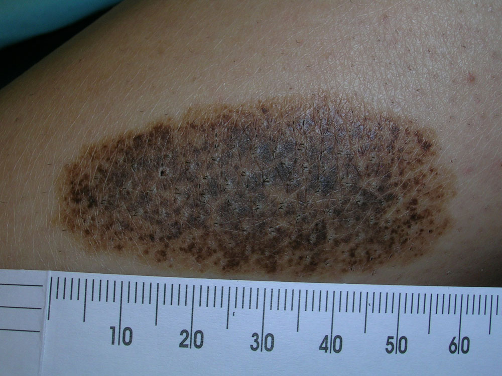 nevus, congenital